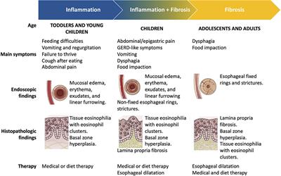 Diet Therapy in Eosinophilic Esophagitis. Focus on a Personalized Approach